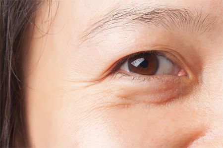 Xuất hiện nếp nhăn ở vùng mắt